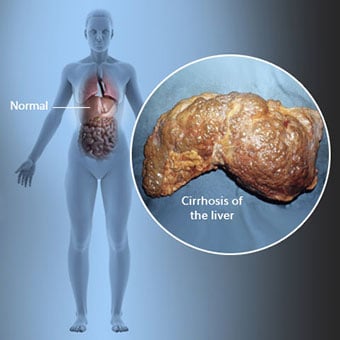 Cirrhosis of Liver Ayurveda Treatment